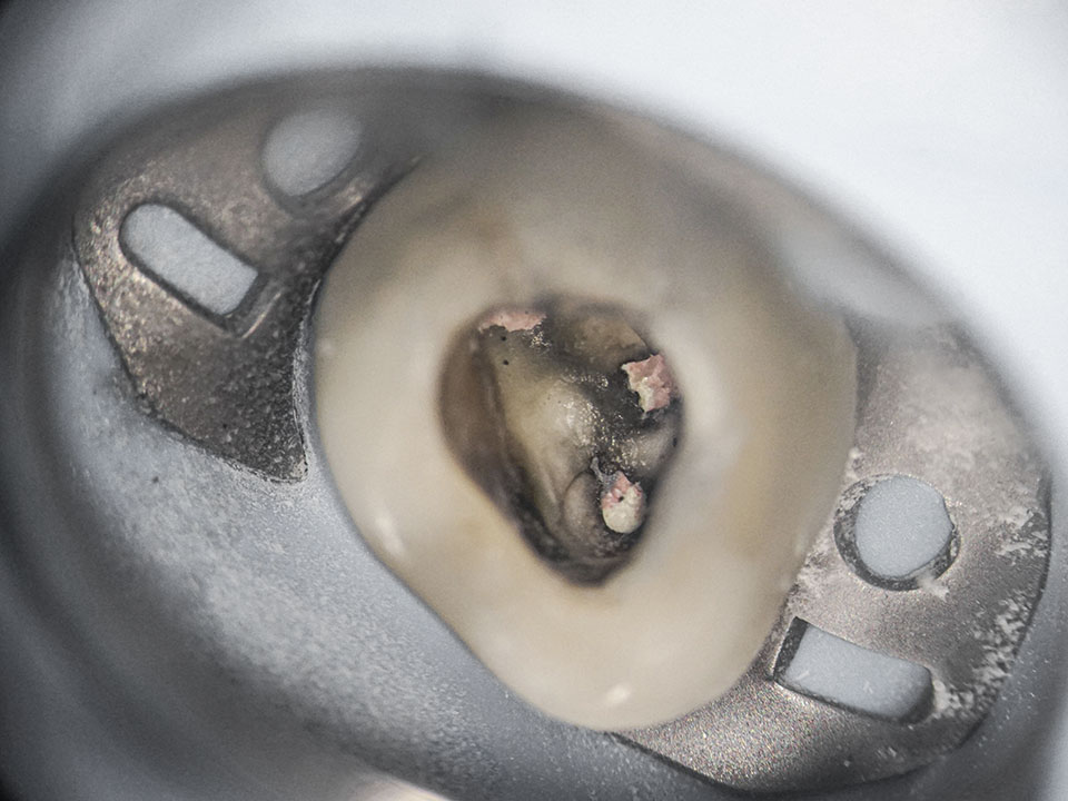 Wurzelkanal Nahaufnahme