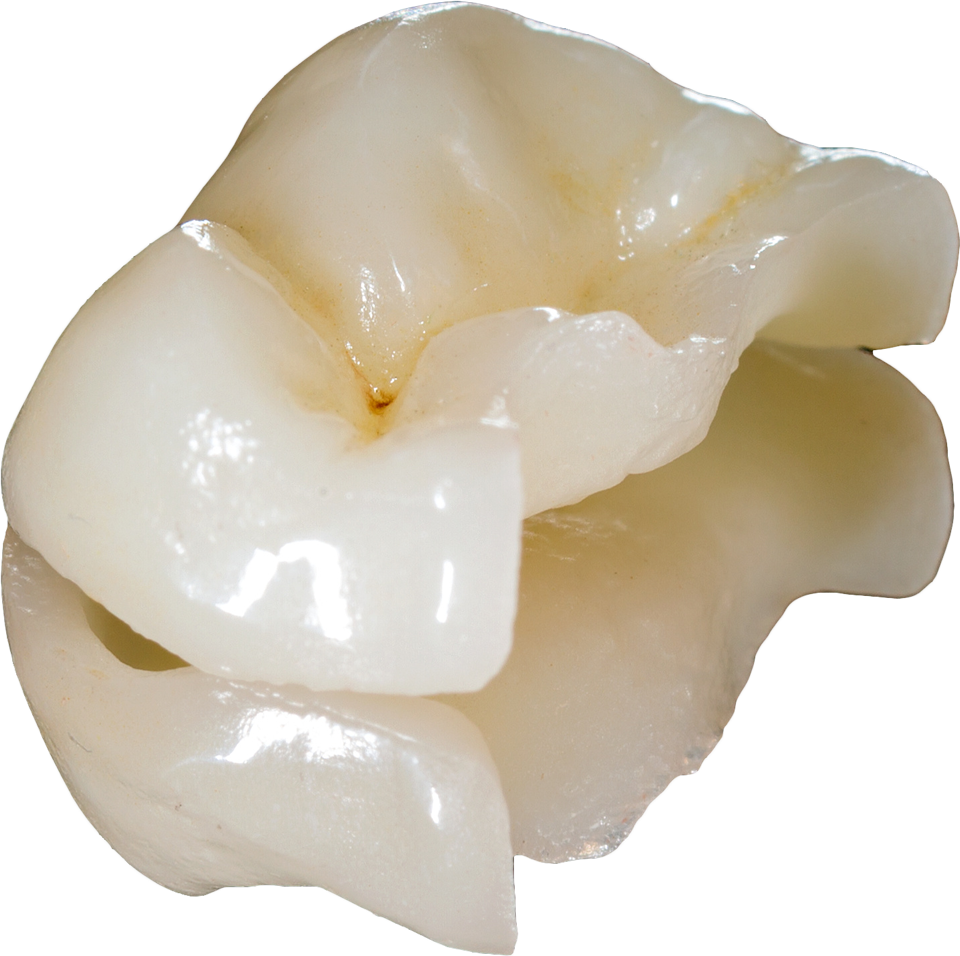 Abblidung der teilkrone