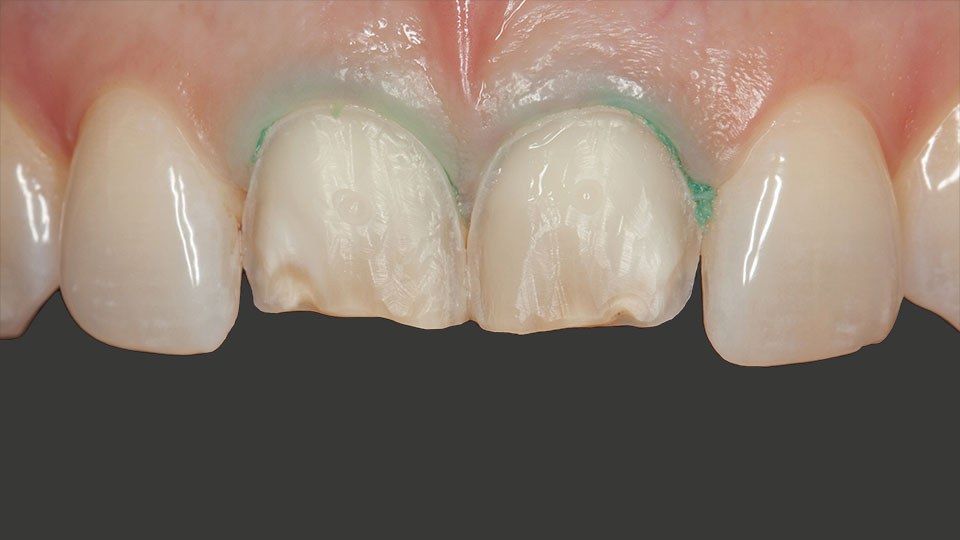Zähne ohne Veneers