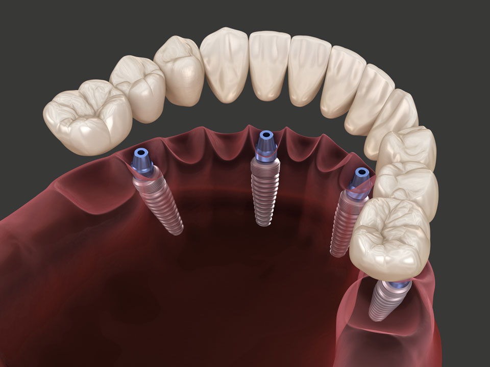 Schema (3D-Rendering) vom Einsatz von Implantaten
