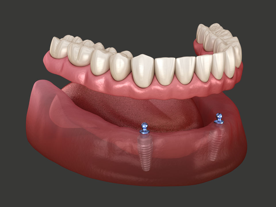 Schema (3D-Rendering) vom Einsatz von Implantaten