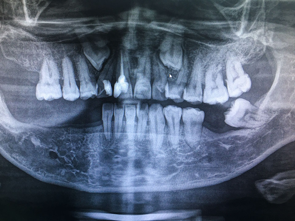Röntgenbild nachher